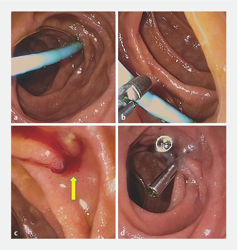 https://cdn.ncbi.nlm.nih.gov/pmc/blobs/151a/7577786/87f1e0800f2d/10-1055-a-1231-4758-i1799ei2.jpg
