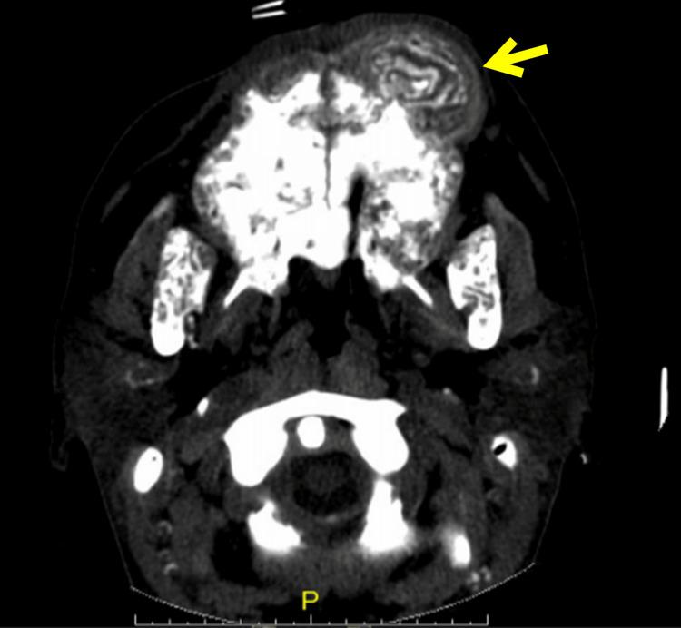 https://cdn.ncbi.nlm.nih.gov/pmc/blobs/151e/12396612/0cceb33f0594/cureus-0017-00000089067-i01.jpg