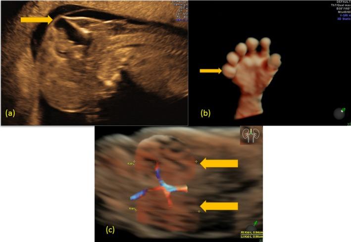 https://cdn.ncbi.nlm.nih.gov/pmc/blobs/1545/6503012/5c65457fea5c/MGG3-7-e614-g001.jpg