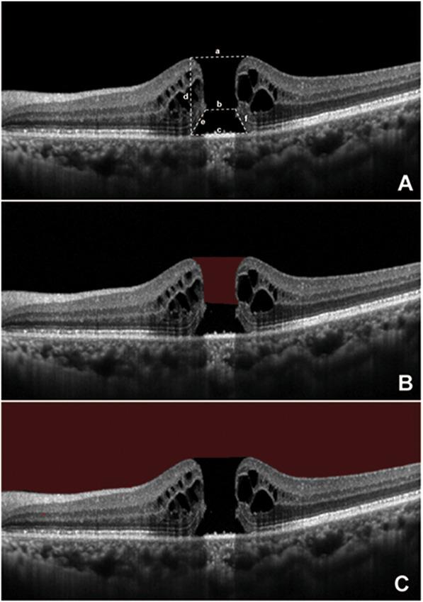 https://cdn.ncbi.nlm.nih.gov/pmc/blobs/1559/10807745/816ef7661524/retina-44-237-g001.jpg