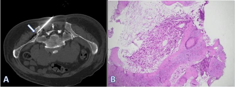 https://cdn.ncbi.nlm.nih.gov/pmc/blobs/1563/12085250/ccb5b34dbd62/cureus-0017-00000082472-i03.jpg