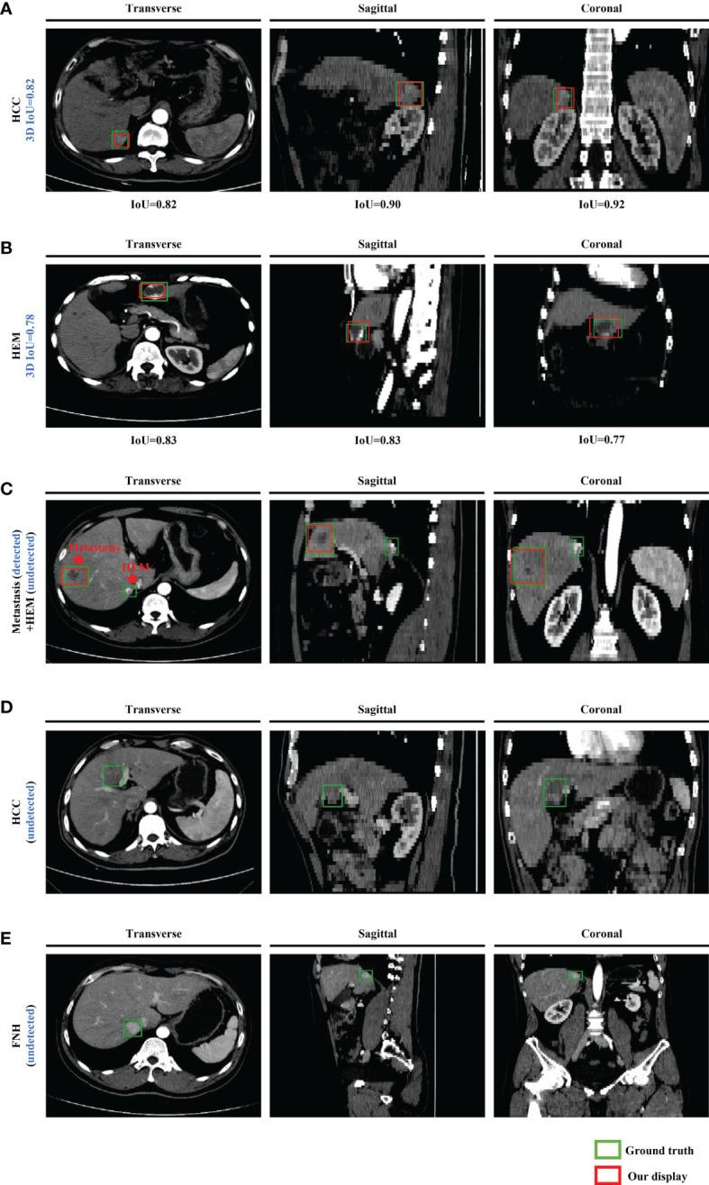 https://cdn.ncbi.nlm.nih.gov/pmc/blobs/1594/7878526/387b8c81b9be/fonc-10-581210-g003.jpg