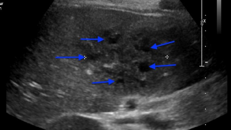https://cdn.ncbi.nlm.nih.gov/pmc/blobs/15b2/11132835/0be780a14cfe/cureus-0016-00000059229-i01.jpg