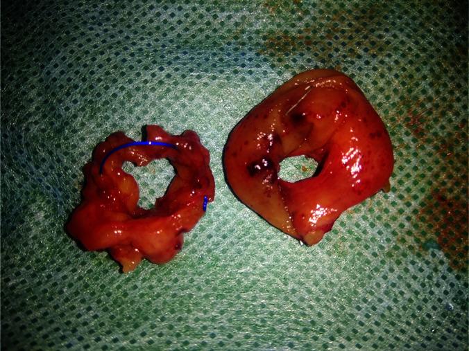 https://cdn.ncbi.nlm.nih.gov/pmc/blobs/15d3/9859653/1f02e498ee99/LS-JSLS220075F007.jpg