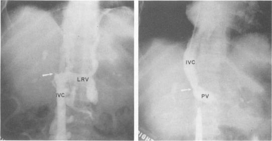 https://cdn.ncbi.nlm.nih.gov/pmc/blobs/163c/1355694/052e58f3be50/annsurg00248-0141-b.jpg