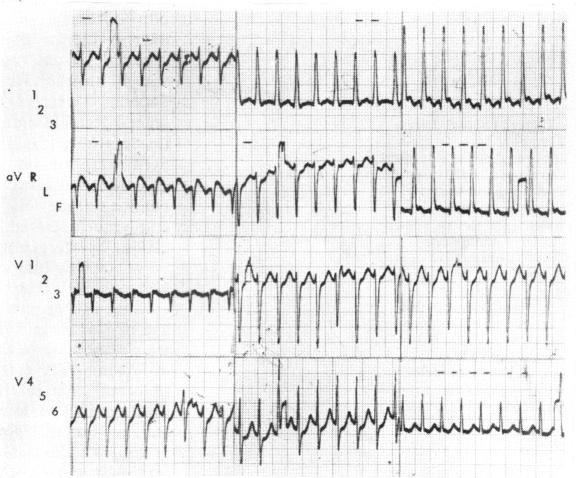 https://cdn.ncbi.nlm.nih.gov/pmc/blobs/1654/486990/2f3a8d910510/brheartj00294-0081-b.jpg