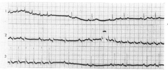 https://cdn.ncbi.nlm.nih.gov/pmc/blobs/1654/486990/47ddc3586115/brheartj00294-0084-b.jpg