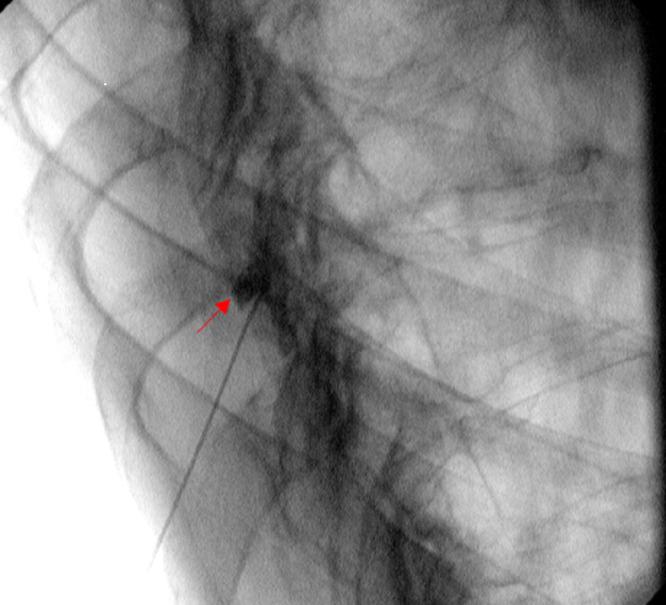 https://cdn.ncbi.nlm.nih.gov/pmc/blobs/1655/9155590/cd68ab6150b9/cureus-0014-00000024651-i05.jpg