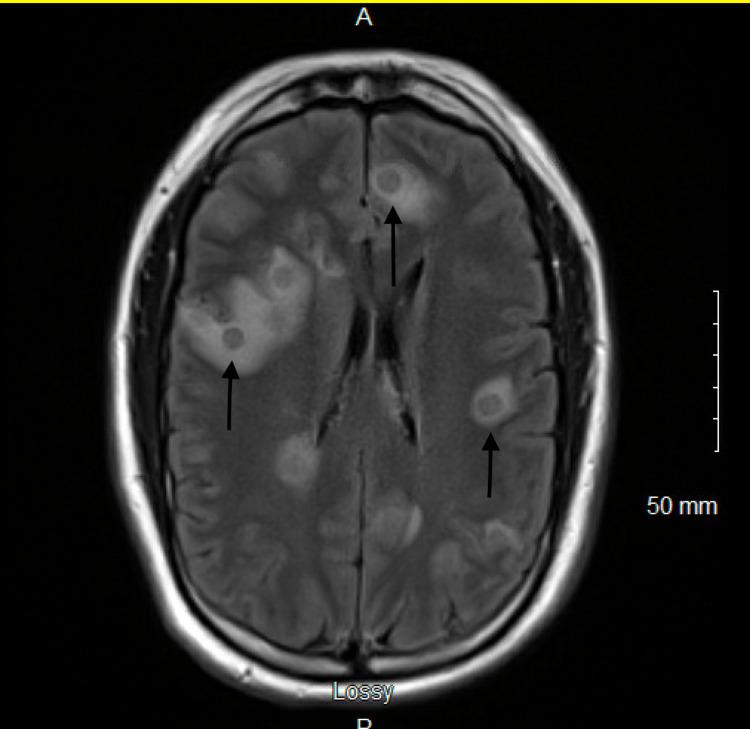 https://cdn.ncbi.nlm.nih.gov/pmc/blobs/166b/9858951/0afd5bd535ff/cureus-0014-00000032797-i02.jpg