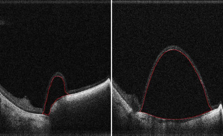 https://cdn.ncbi.nlm.nih.gov/pmc/blobs/1686/8212437/7170020ba43e/tvst-10-7-24-f006.jpg