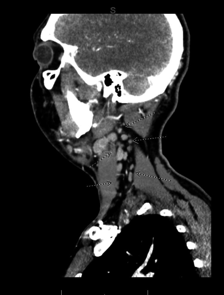https://cdn.ncbi.nlm.nih.gov/pmc/blobs/16a8/11747970/05cf6a996593/cureus-0016-00000075976-i04.jpg