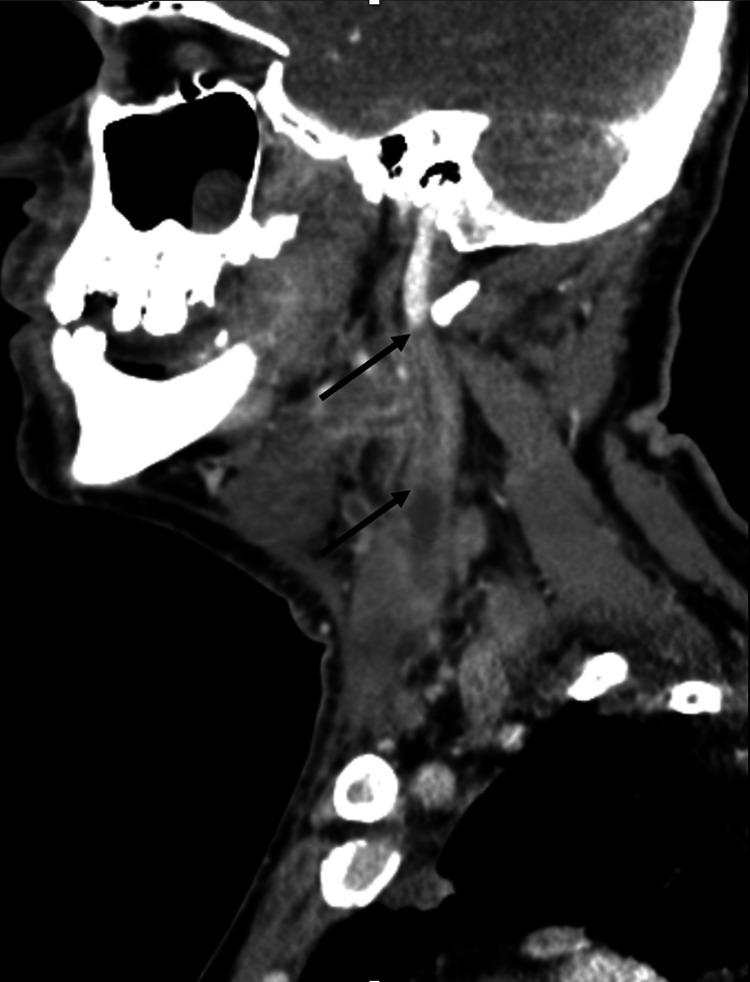 https://cdn.ncbi.nlm.nih.gov/pmc/blobs/16a8/11747970/cd8a65a02704/cureus-0016-00000075976-i06.jpg