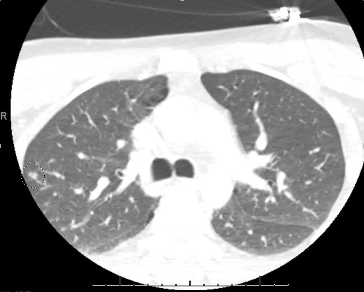 https://cdn.ncbi.nlm.nih.gov/pmc/blobs/16a8/11747970/e9ac1dd3b2b9/cureus-0016-00000075976-i05.jpg