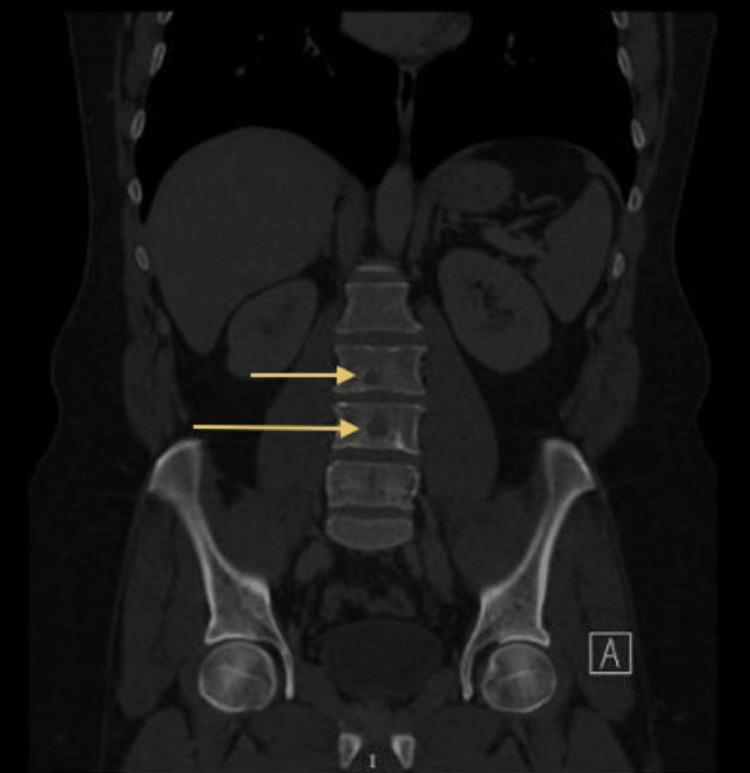 https://cdn.ncbi.nlm.nih.gov/pmc/blobs/1736/9904514/32386e7c15e1/cureus-0015-00000033505-i03.jpg