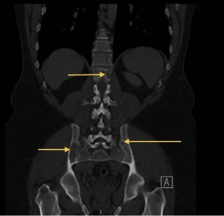 https://cdn.ncbi.nlm.nih.gov/pmc/blobs/1736/9904514/eab1e0d1d3d1/cureus-0015-00000033505-i04.jpg