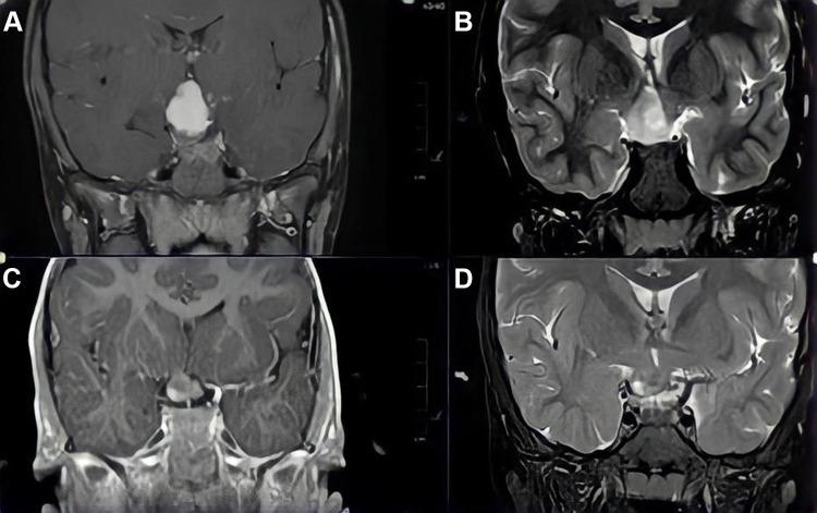 https://cdn.ncbi.nlm.nih.gov/pmc/blobs/175b/9444037/022fb1217a3a/OPTH-16-2933-g0001.jpg
