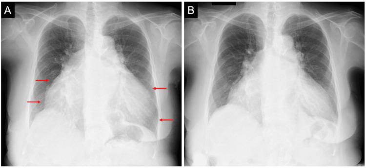 https://cdn.ncbi.nlm.nih.gov/pmc/blobs/1777/11571103/988b786419b7/cureus-0016-00000071844-i02.jpg