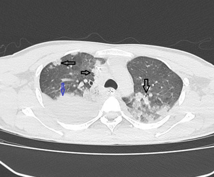 https://cdn.ncbi.nlm.nih.gov/pmc/blobs/1796/10766567/0bf6959df685/cureus-0015-00000050003-i01.jpg