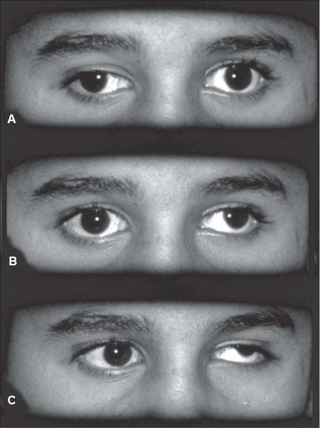https://cdn.ncbi.nlm.nih.gov/pmc/blobs/17a9/2636021/7078df681500/IndianJOphthalmol-55-388-g001.jpg