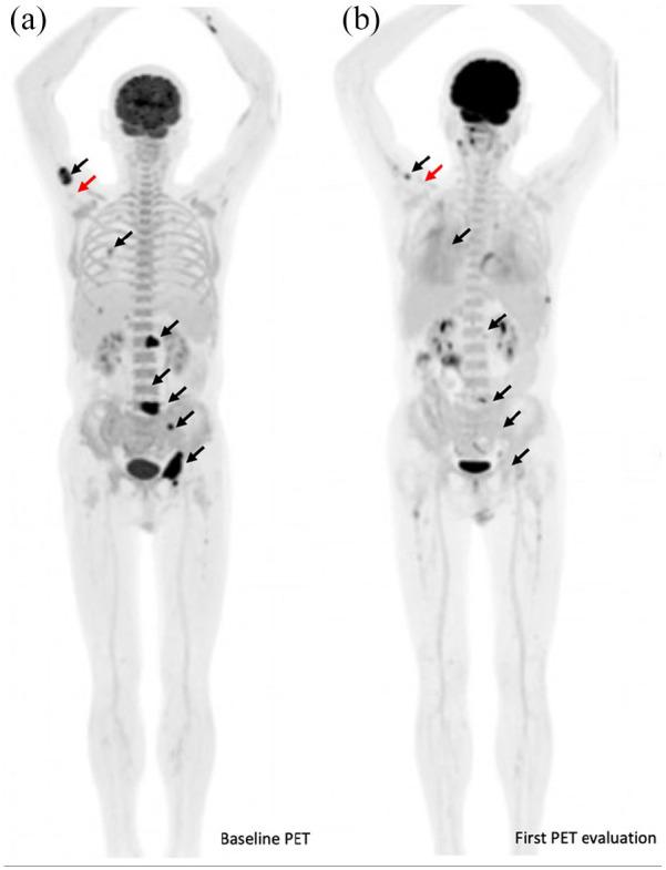 https://cdn.ncbi.nlm.nih.gov/pmc/blobs/182a/9083034/91981d11fd77/10.1177_17588359221096877-fig1.jpg