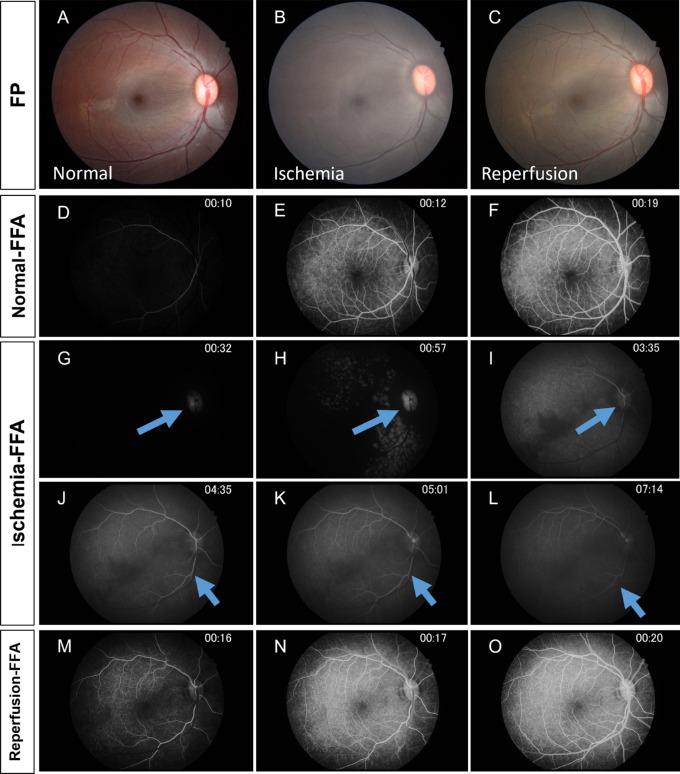 https://cdn.ncbi.nlm.nih.gov/pmc/blobs/1873/10289273/5fde12790800/tvst-12-6-14-f002.jpg
