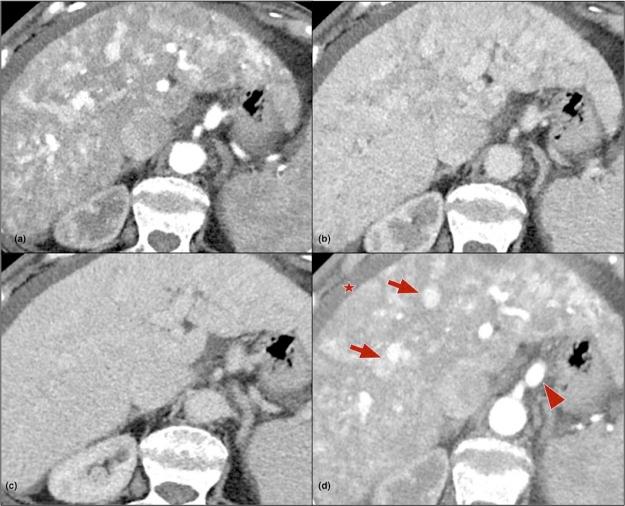 https://cdn.ncbi.nlm.nih.gov/pmc/blobs/18bd/5851303/3062a320040e/radcr369-fig-0003.jpg
