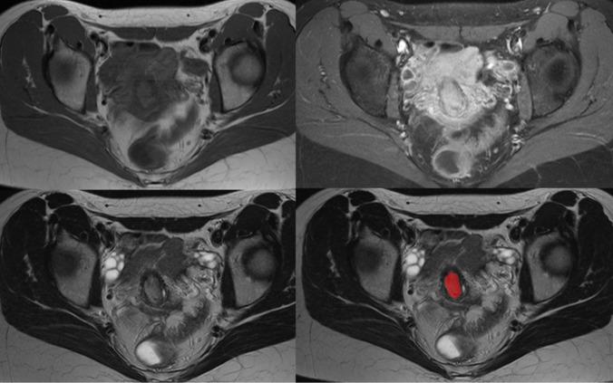 https://cdn.ncbi.nlm.nih.gov/pmc/blobs/18f9/12279667/abfb7ade34ec/432_2025_6253_Fig1_HTML.jpg