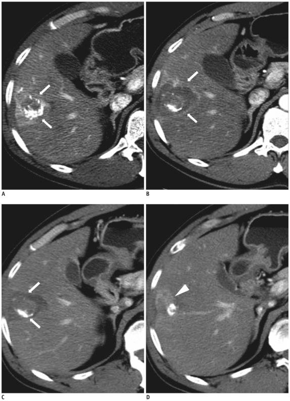 https://cdn.ncbi.nlm.nih.gov/pmc/blobs/1918/3341453/f0d59fd216ca/kjr-13-S104-g002.jpg