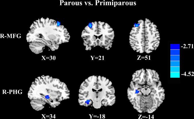 https://cdn.ncbi.nlm.nih.gov/pmc/blobs/1933/9444322/e69eeeb9c887/fnagi-14-963943-g001.jpg