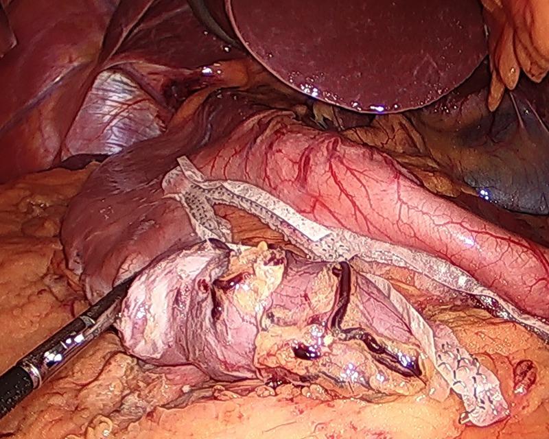 https://cdn.ncbi.nlm.nih.gov/pmc/blobs/1978/6300189/e6ebac95e9e1/cureus-0010-00000003464-i03.jpg