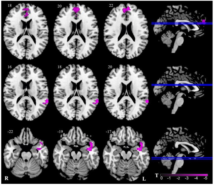 https://cdn.ncbi.nlm.nih.gov/pmc/blobs/199a/9954115/e1e2bafe713f/brainsci-13-00183-g002.jpg