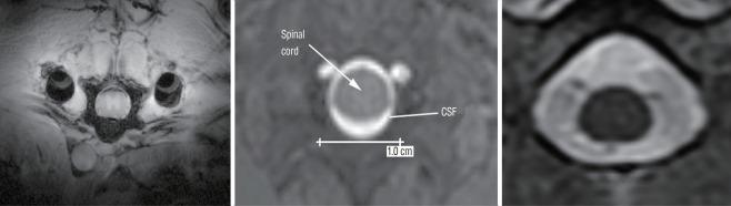 https://cdn.ncbi.nlm.nih.gov/pmc/blobs/1a08/6129752/1d0cb825413c/jkns-2017-0276f1.jpg