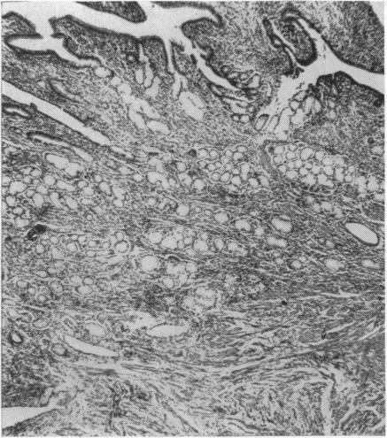 https://cdn.ncbi.nlm.nih.gov/pmc/blobs/1a67/1413264/1adccf596306/gut00678-0013-a.jpg