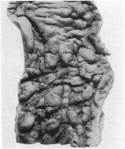 https://cdn.ncbi.nlm.nih.gov/pmc/blobs/1a67/1413264/1e55cfa3289d/gut00678-0011-b.jpg