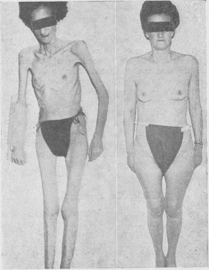 https://cdn.ncbi.nlm.nih.gov/pmc/blobs/1a79/1844425/e2705263d6a4/brmedj02547-0026-a.jpg