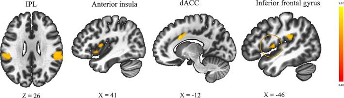 https://cdn.ncbi.nlm.nih.gov/pmc/blobs/1a9b/8764470/081b080db172/HBM-43-974-g003.jpg