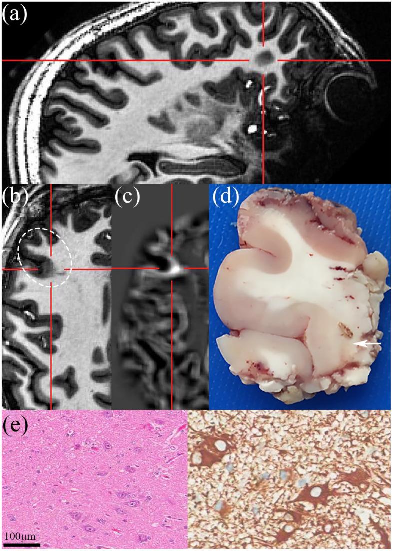 https://cdn.ncbi.nlm.nih.gov/pmc/blobs/1b1b/8191069/096d1341a807/10.1177_17562864211021181-fig3.jpg