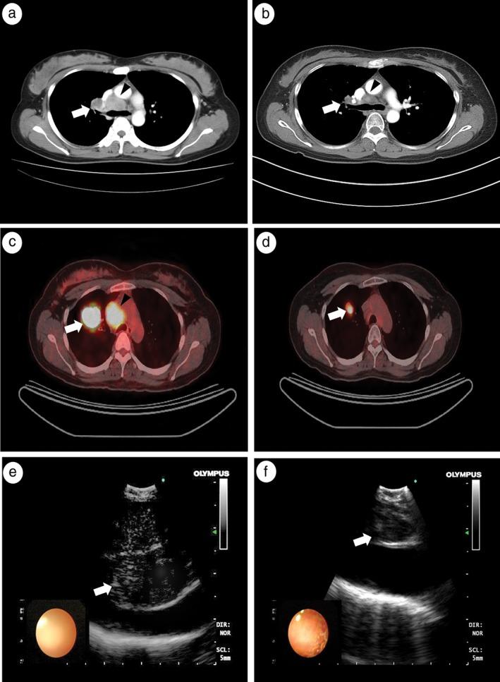 https://cdn.ncbi.nlm.nih.gov/pmc/blobs/1b61/5983197/1fb359b8e3ae/TCA-9-684-g002.jpg