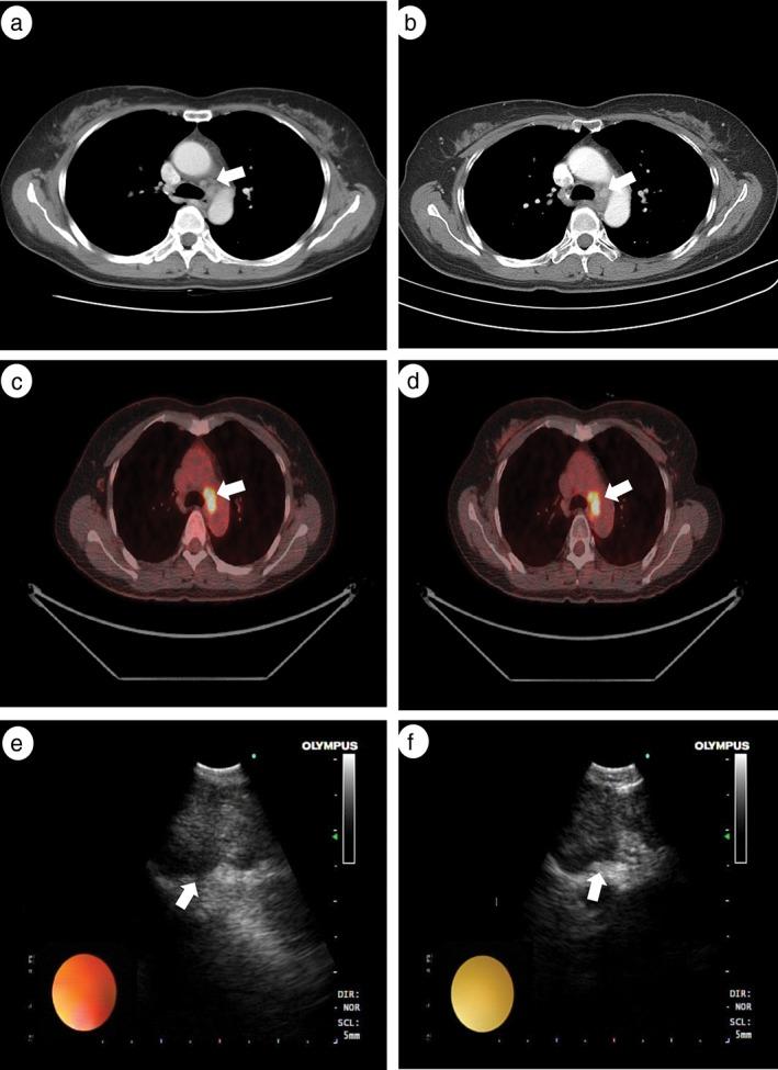 https://cdn.ncbi.nlm.nih.gov/pmc/blobs/1b61/5983197/97fcaa36c7ad/TCA-9-684-g003.jpg