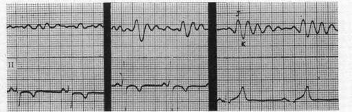 https://cdn.ncbi.nlm.nih.gov/pmc/blobs/1b80/479566/36106926a245/brheartj00389-0113-b.jpg