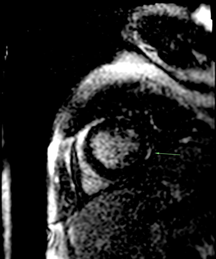 https://cdn.ncbi.nlm.nih.gov/pmc/blobs/1ba0/11723568/55e83459839a/cureus-0016-00000075550-i05.jpg