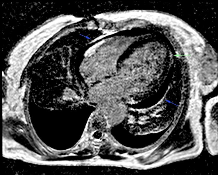 https://cdn.ncbi.nlm.nih.gov/pmc/blobs/1ba0/11723568/884f730b1ce5/cureus-0016-00000075550-i04.jpg