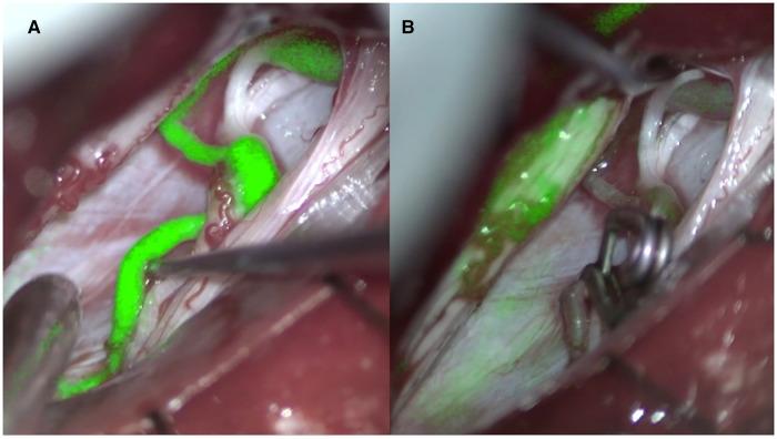 https://cdn.ncbi.nlm.nih.gov/pmc/blobs/1bde/10111007/c3524aa9e881/fsurg-10-1148968-g002.jpg