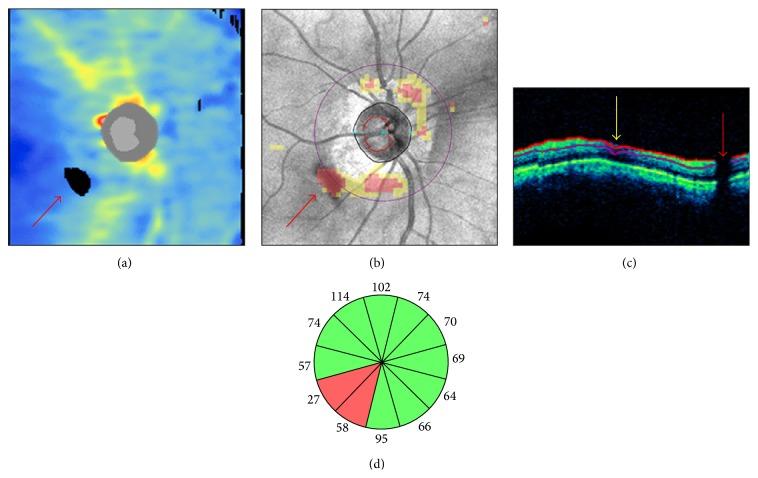 https://cdn.ncbi.nlm.nih.gov/pmc/blobs/1bf1/4550770/b007853852b6/JOPH2015-746150.002.jpg