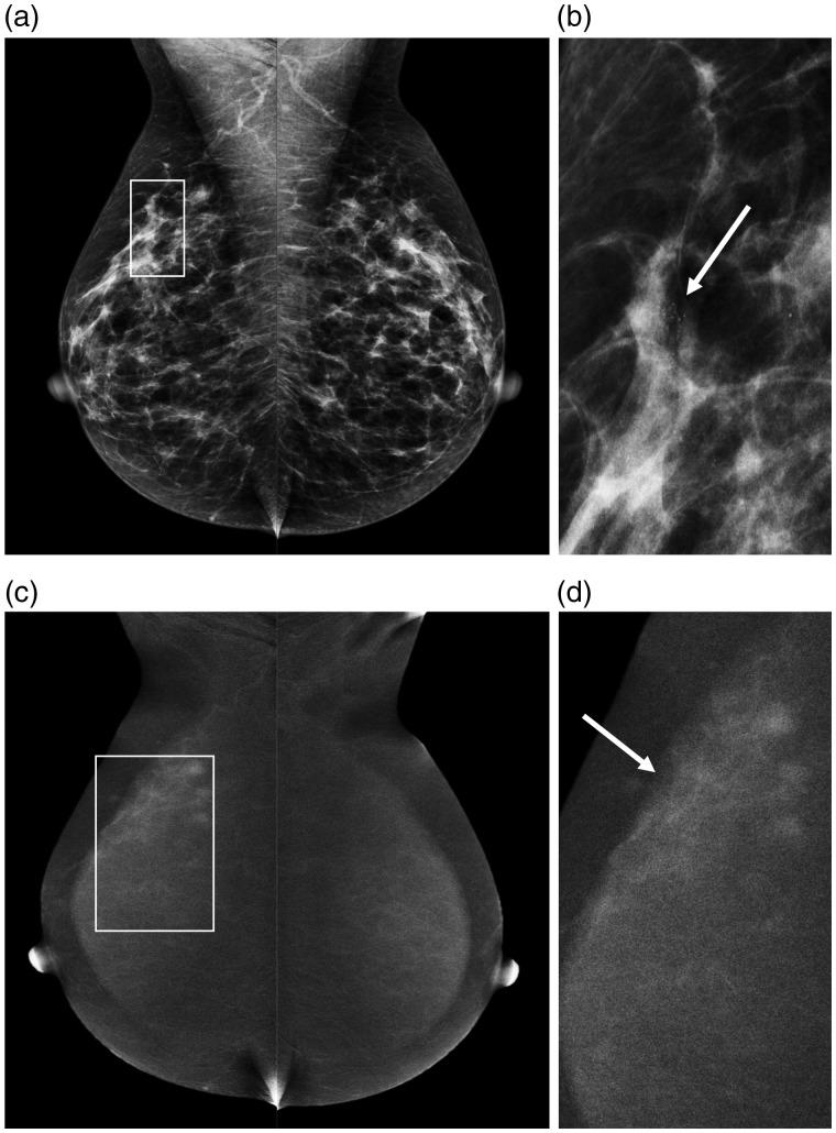https://cdn.ncbi.nlm.nih.gov/pmc/blobs/1c15/6691602/acdee9941077/10.1177_0284185118822639-fig4.jpg