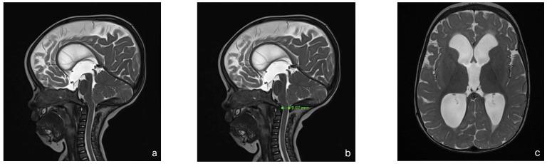 https://cdn.ncbi.nlm.nih.gov/pmc/blobs/1c23/12191941/a872dbaedd05/children-12-00662-g002a.jpg