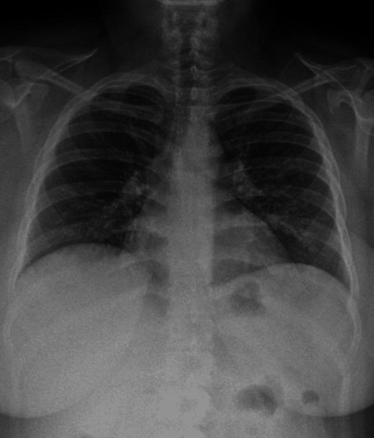 https://cdn.ncbi.nlm.nih.gov/pmc/blobs/1c5e/10925074/14e66480a029/cureus-0016-00000053904-i03.jpg