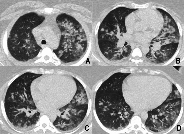 https://cdn.ncbi.nlm.nih.gov/pmc/blobs/1c5e/10925074/49a3de240a29/cureus-0016-00000053904-i02.jpg
