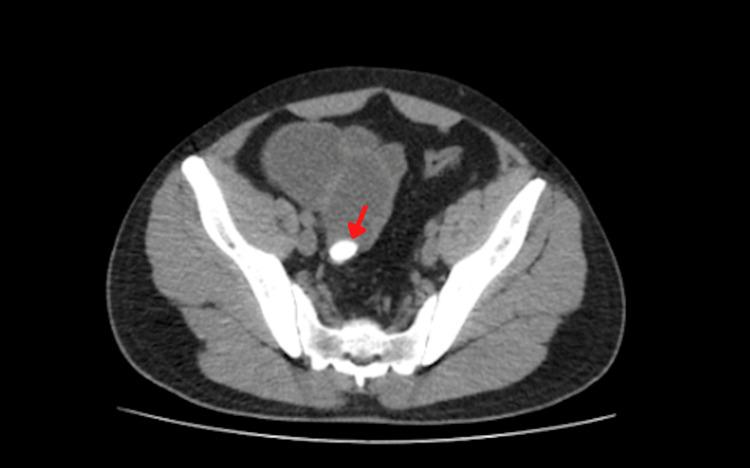 https://cdn.ncbi.nlm.nih.gov/pmc/blobs/1c61/9894643/808b7c742111/cureus-0015-00000033291-i03.jpg