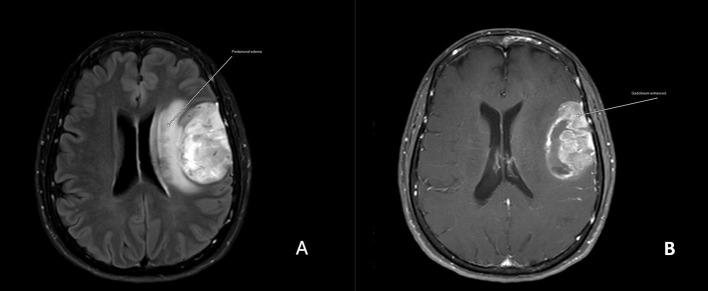 https://cdn.ncbi.nlm.nih.gov/pmc/blobs/1c62/11913685/65225a7e0470/fneur-16-1523468-g002.jpg
